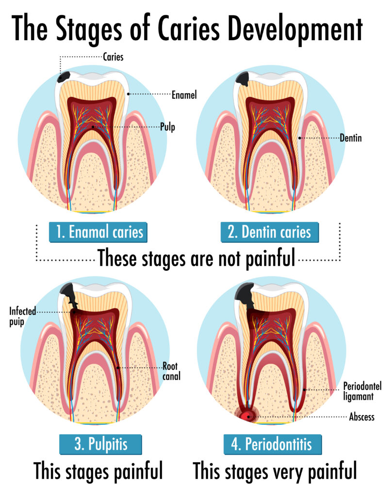 Inforgraphic Human stages caries development